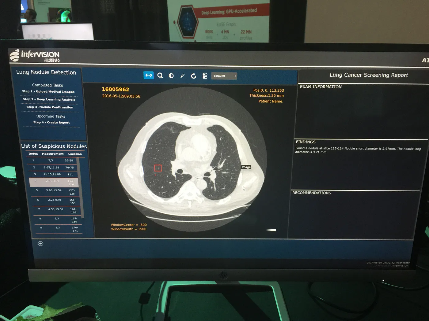 The Power of Artificial Intelligence (AI), Virtual and Augmented Reality (VR and AR) on Medical Imaging at GPU Tech Conference (GTC) 2017