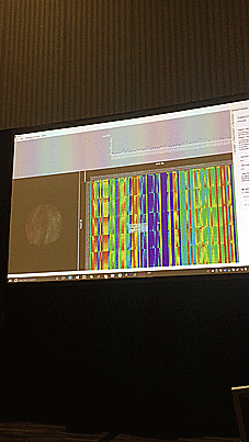 The Power of Artificial Intelligence (AI), Virtual and Augmented Reality (VR and AR) on Medical Imaging at GPU Tech Conference (GTC) 2017